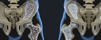 Bone Density-1